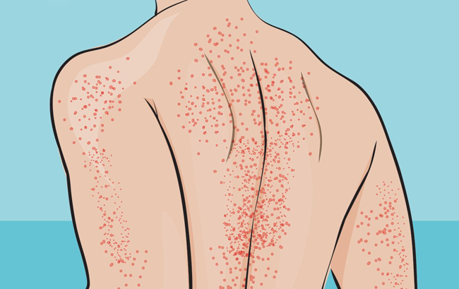 What is Thrombocytopenia
