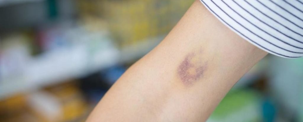 Internal bleeding is included in severe cases